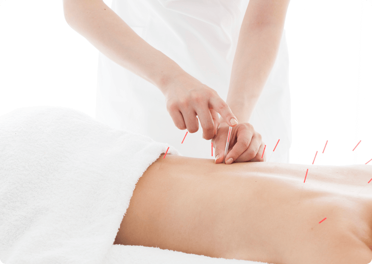 ヒトの鍼灸治療